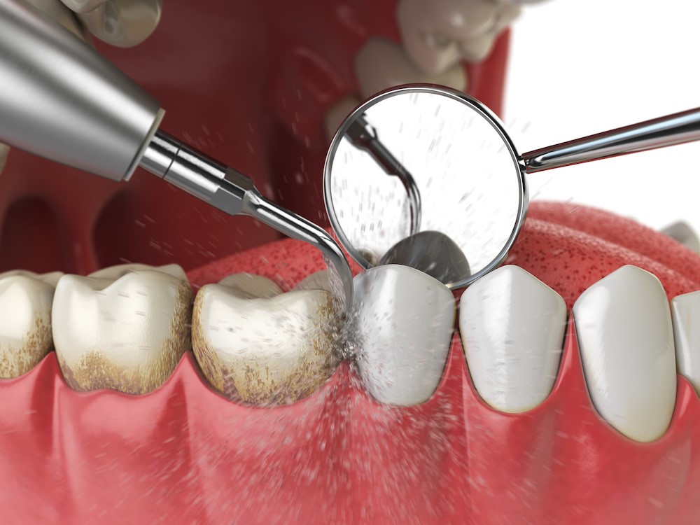 Dental-Implants