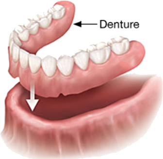 Removable_Dentures