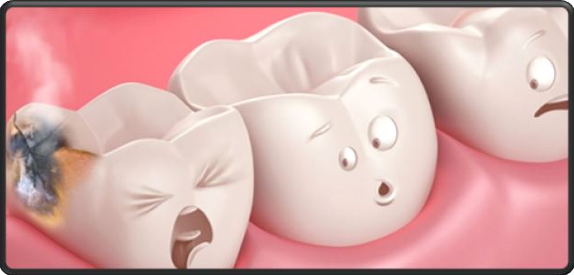 Dental fillings