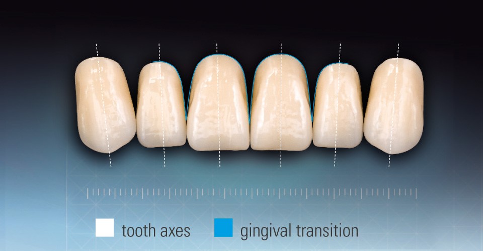 Dental-Implants