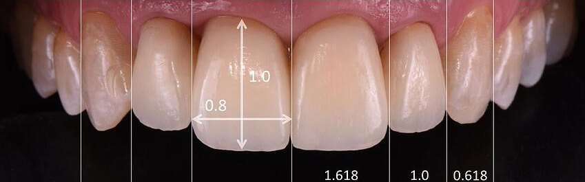 Dental-Implants