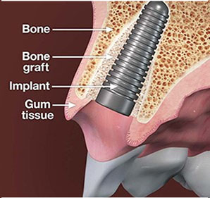 Bone-Graft-Procedures-and-Dental-Implant-Placement