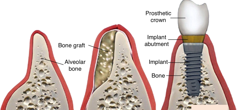 Bone-Grafting-Before-Dental-Implants