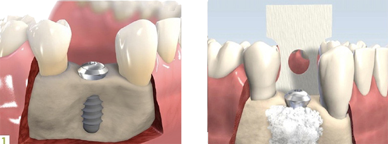 Implant-Placement-and-Simultaneous-Bone-Grafting