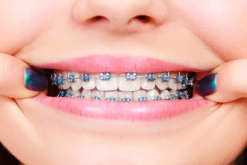 Metal_or_Traditional_Braces