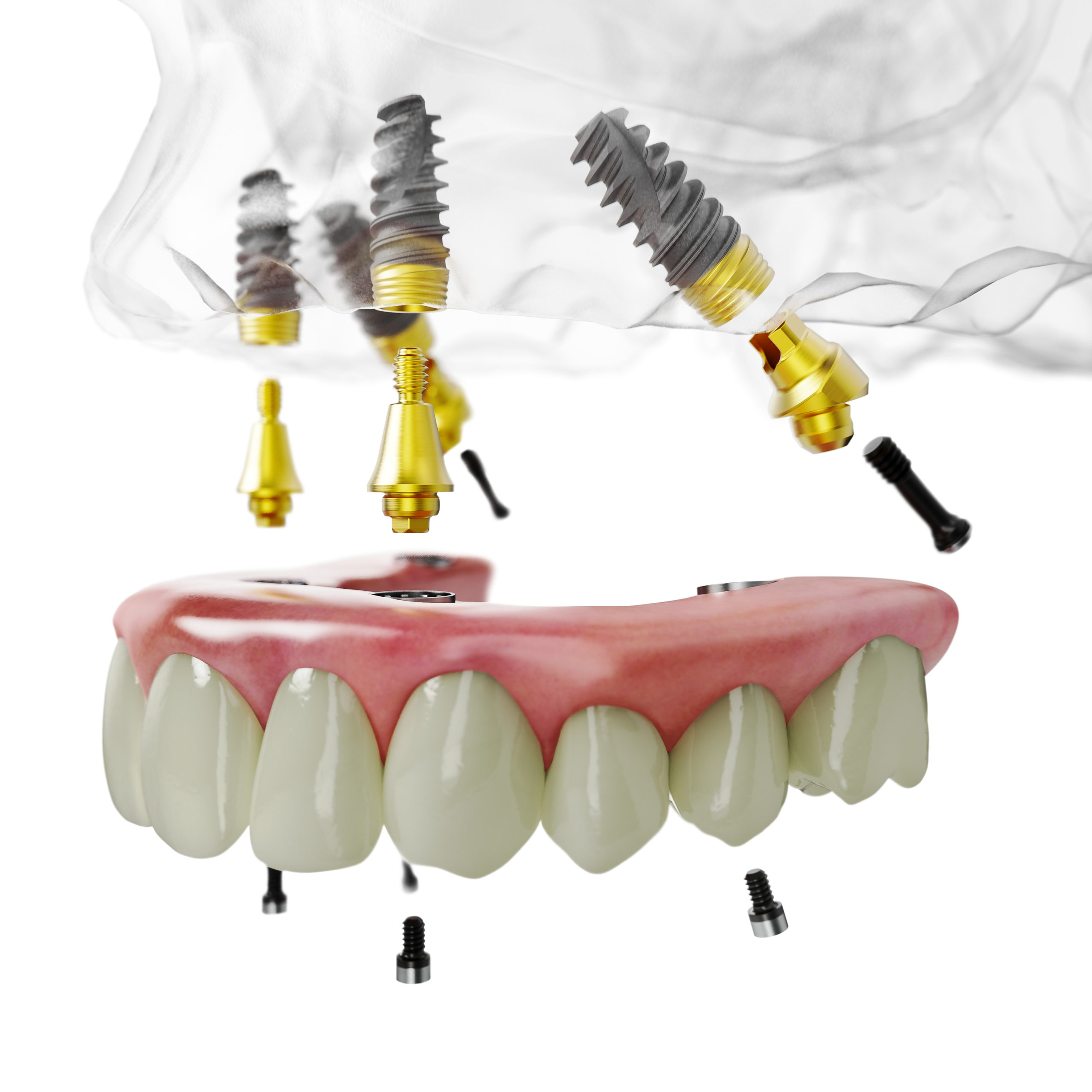 Damon-&-Insignia-Braces