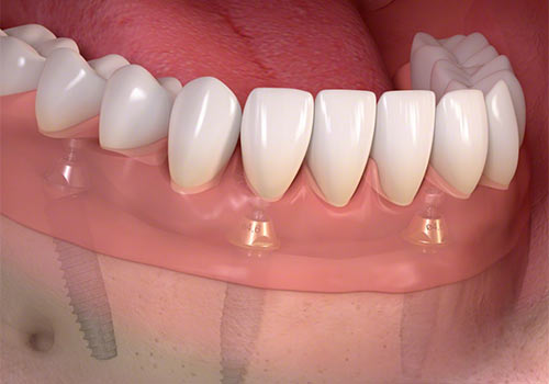 Damon-&-Insignia-Braces