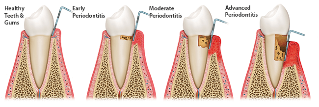 gum_disease