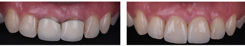 Dental_Crowns