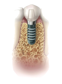 Dental-Implants