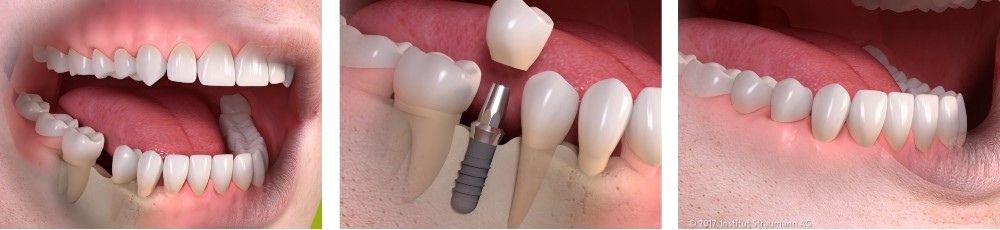 Dental-Implants