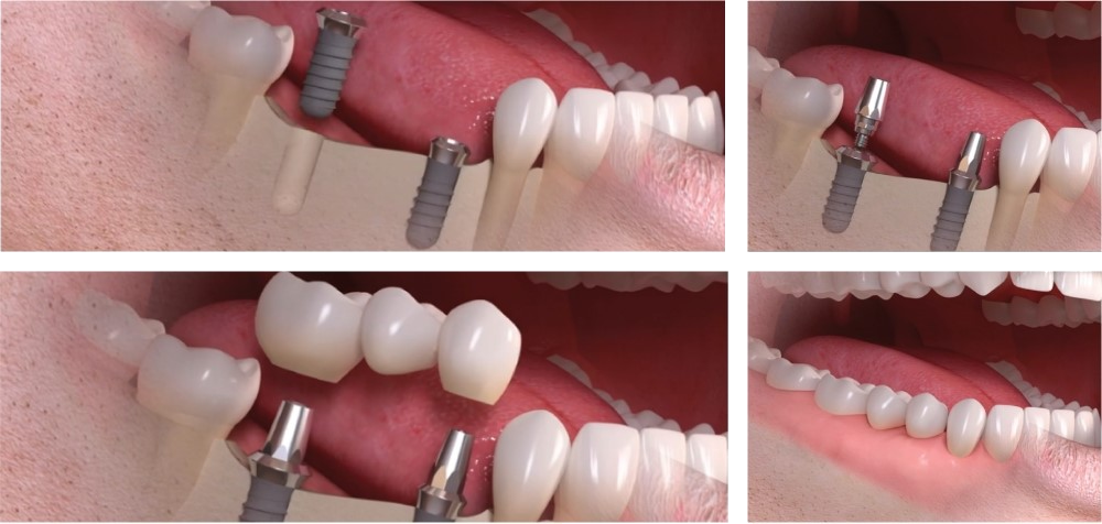 Dental-Implants