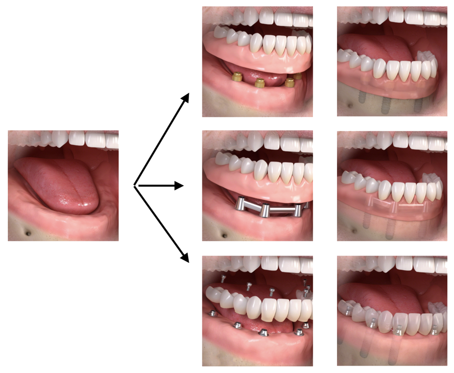 Dental-Implants