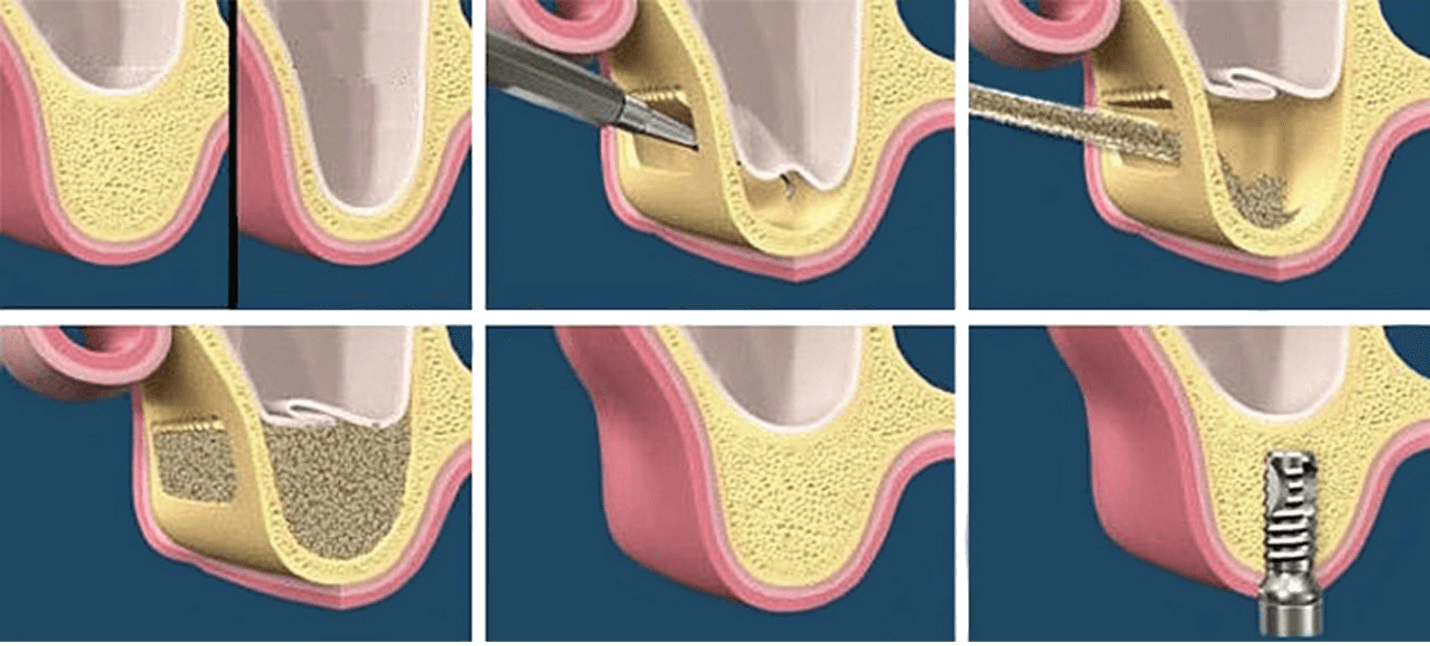 Sinus_lifting