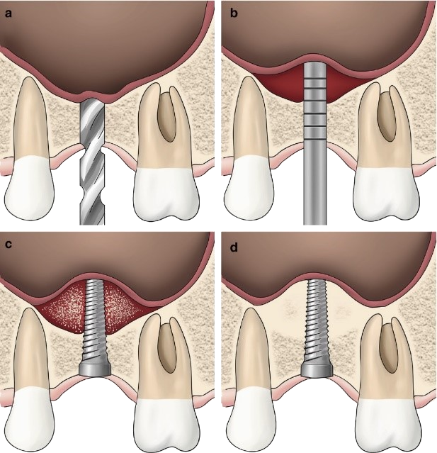 Sinus_lifting