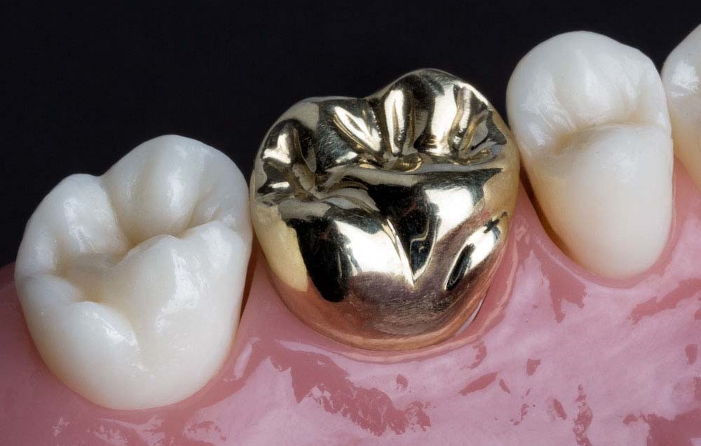 Dental_Crowns