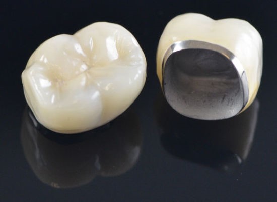 Dental_Crowns