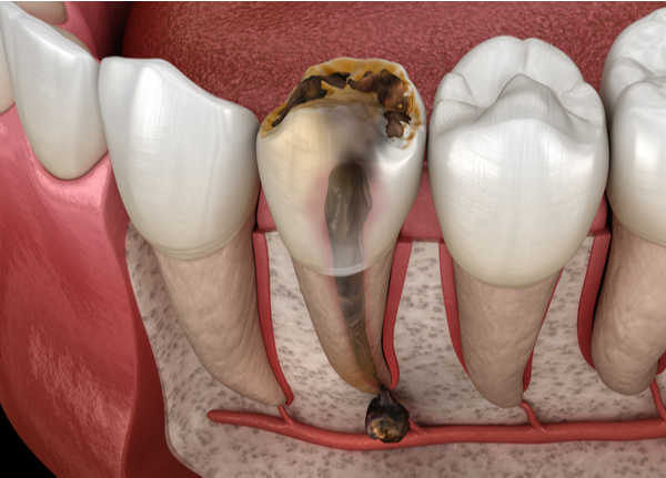 Root_Canal_Treatment