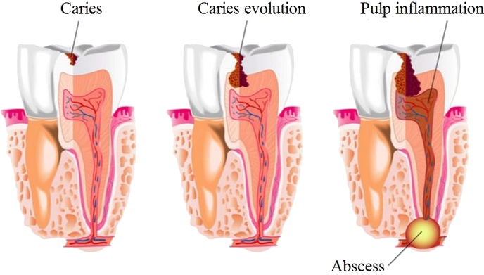 Root_Canal_Treatment