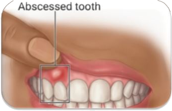 Root_Canal_Treatment