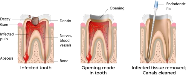 Root_Canal_Treatment