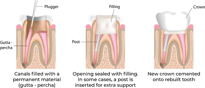 Root_Canal_Treatment