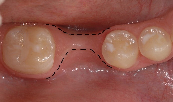 Gums_and_Jawbone