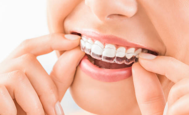 Teeth_Whitening_تبييض _لأسنان