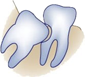 Damage_to_Nearby_Molars