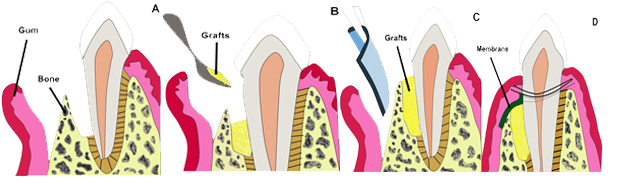 Gum_disease