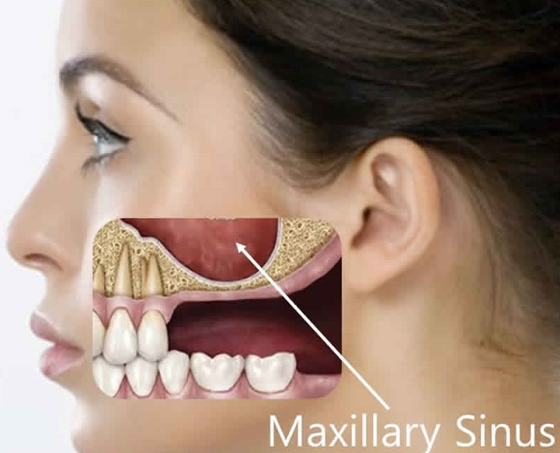 Sinus_lifting