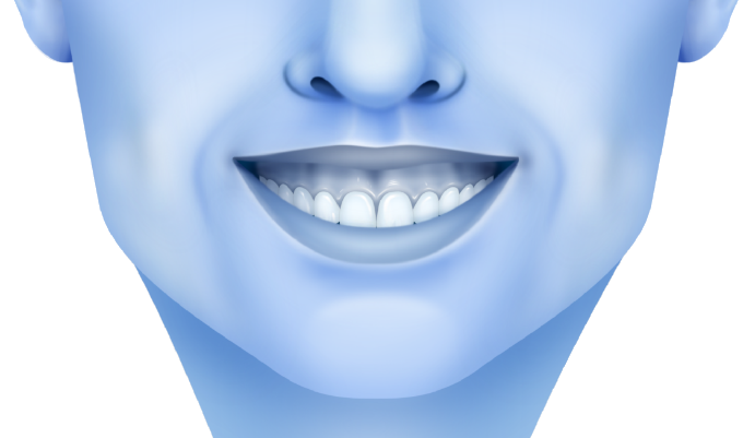 gummy_smile