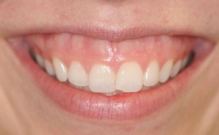 lip_surgery